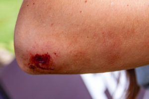 contusions and lacerations