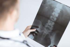 Norcross Spinal Injury Lawyer