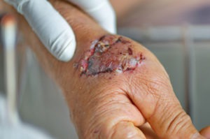 What Are the Signs of Dog Bite Infections?