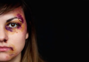 a woman with bruises on her face