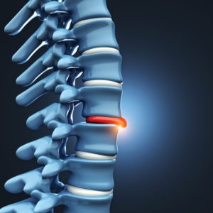 3d rendering of herniated disc on spine